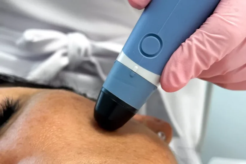 Zvýhodněný balíček 3 ošetření Termolifting obličeje BASIC A s 10% slevou